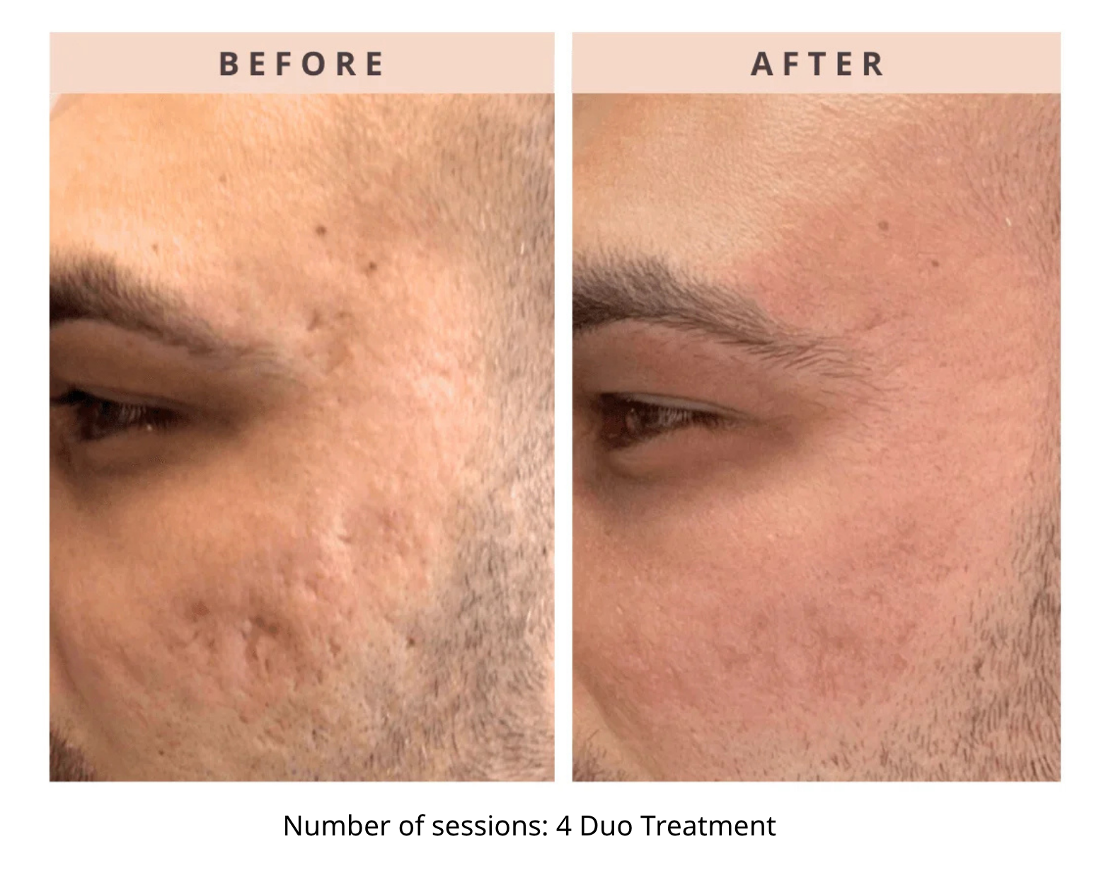 Before and After RF Microneedling and Tetra Pro