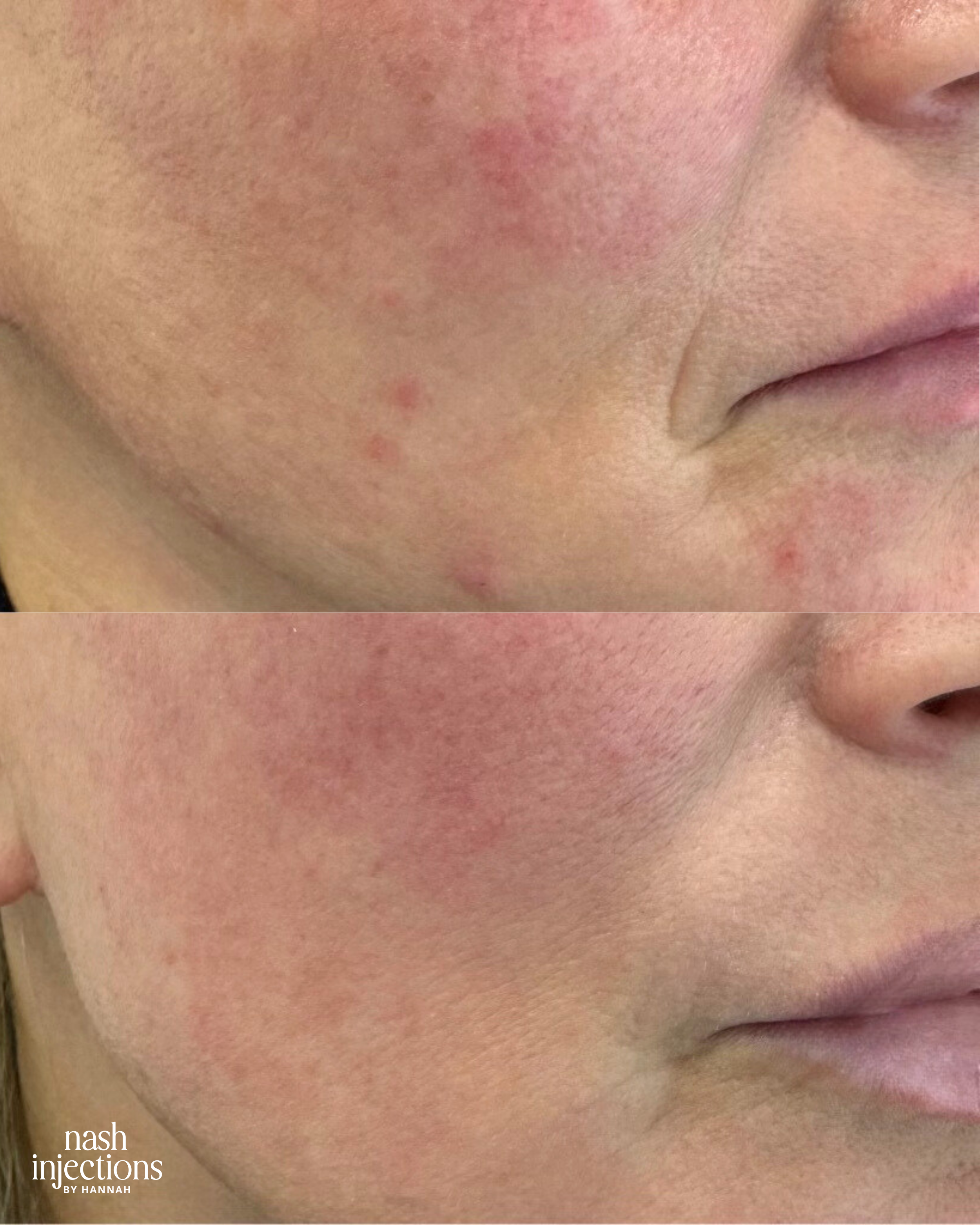 Before and After SkinVive Injections