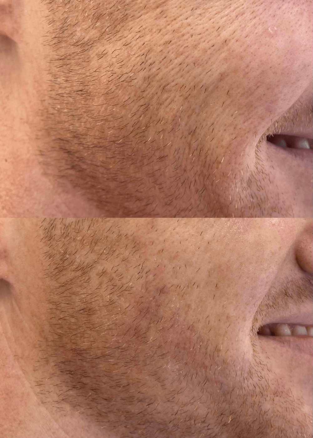 Before and after SkinVive Injections