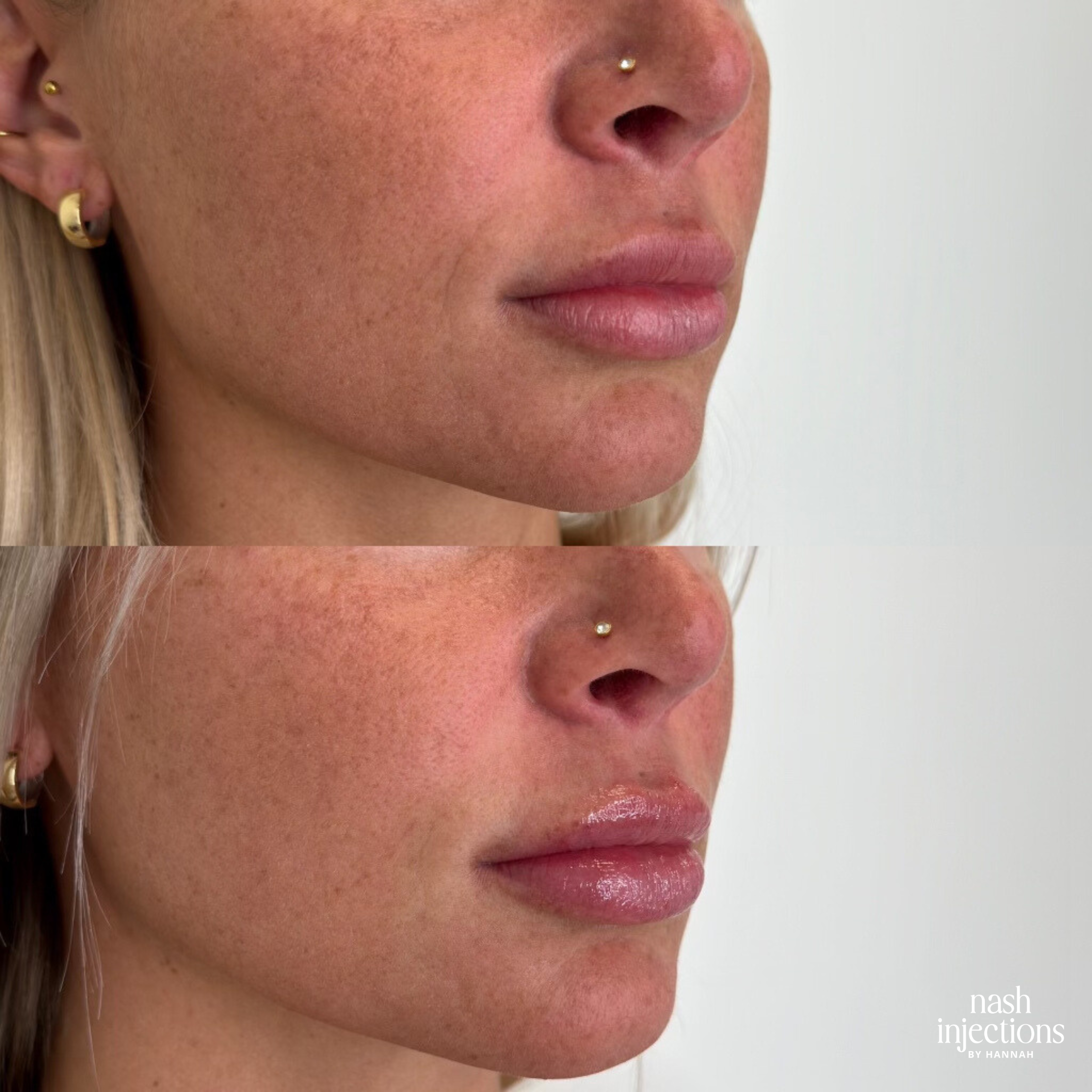 Before and After Lip Filler