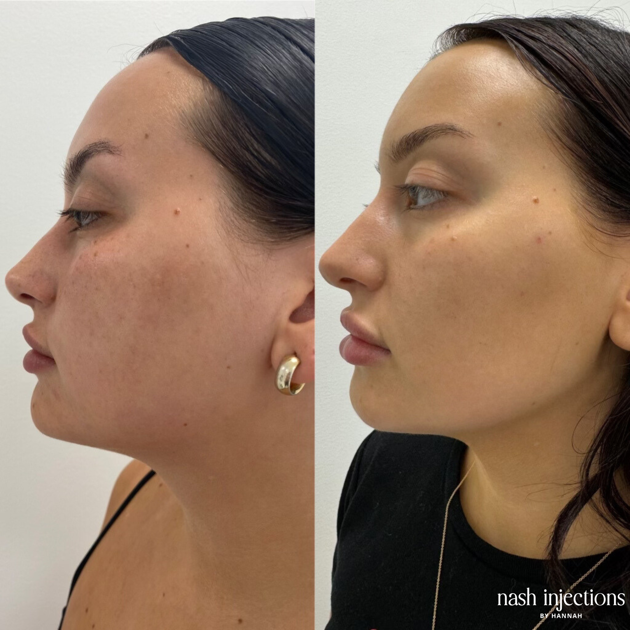 Before and After Cheek, Chin, and Jawline Filler