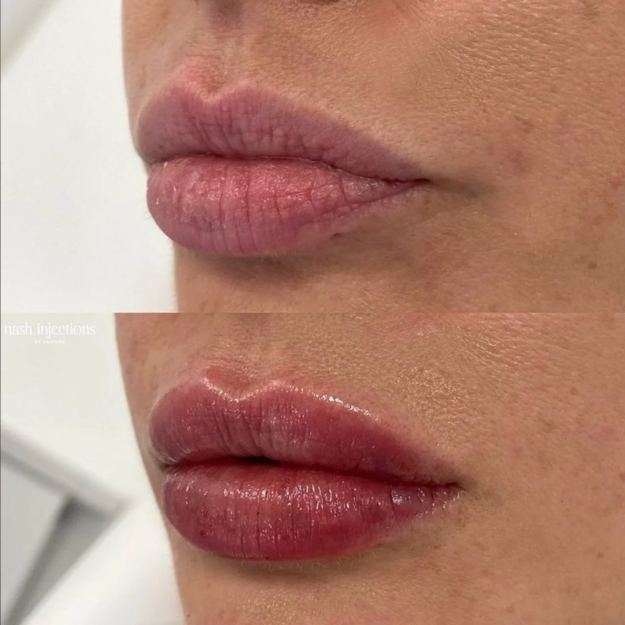 Before and After RHA Lip Filler