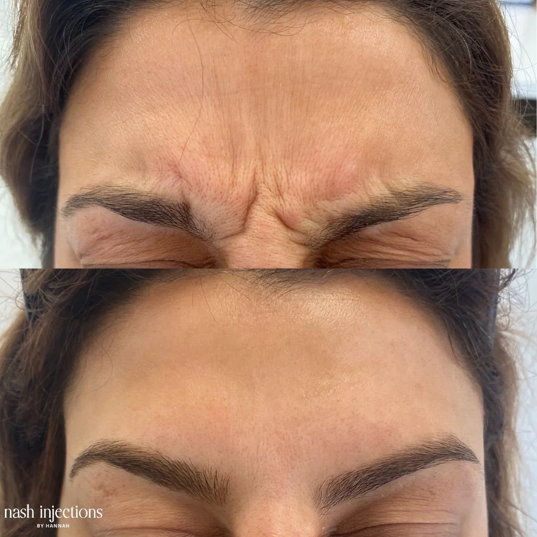 Before and After Botox for Frown Lines