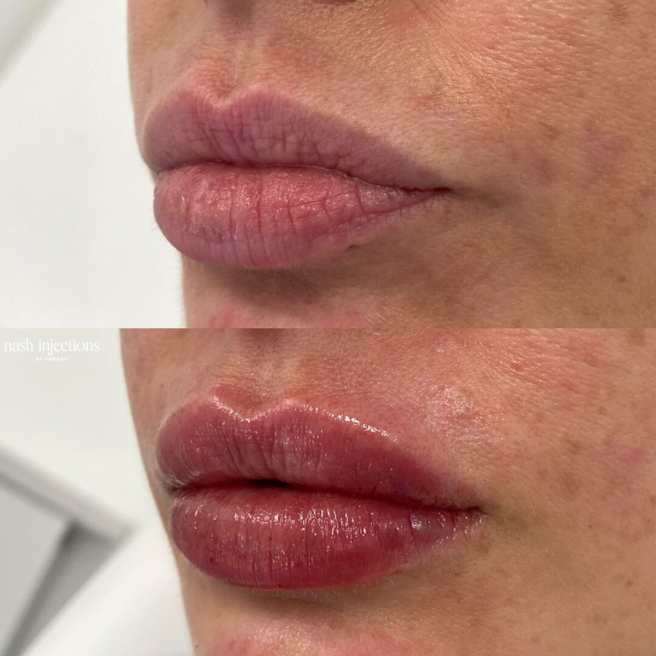 Before and After Lip Filler and Lip Flip