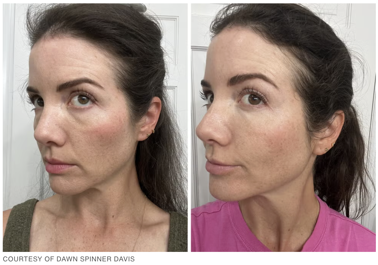 Before and after PRP injections for dark circles