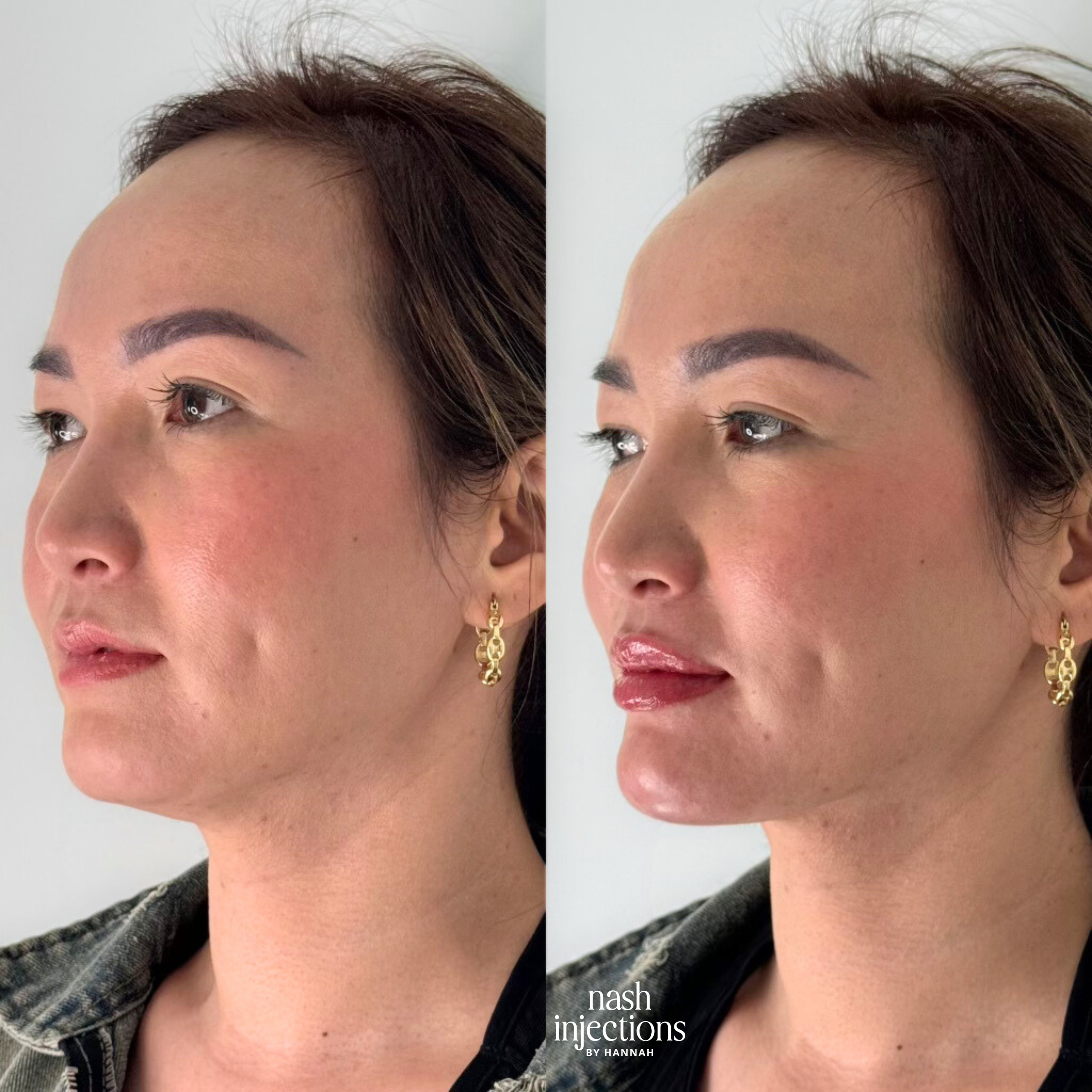 Before and after facial balancing