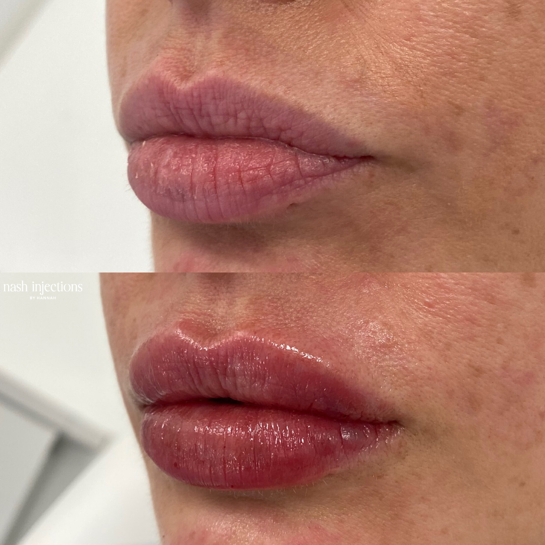 Best Lip Filler in Nashville