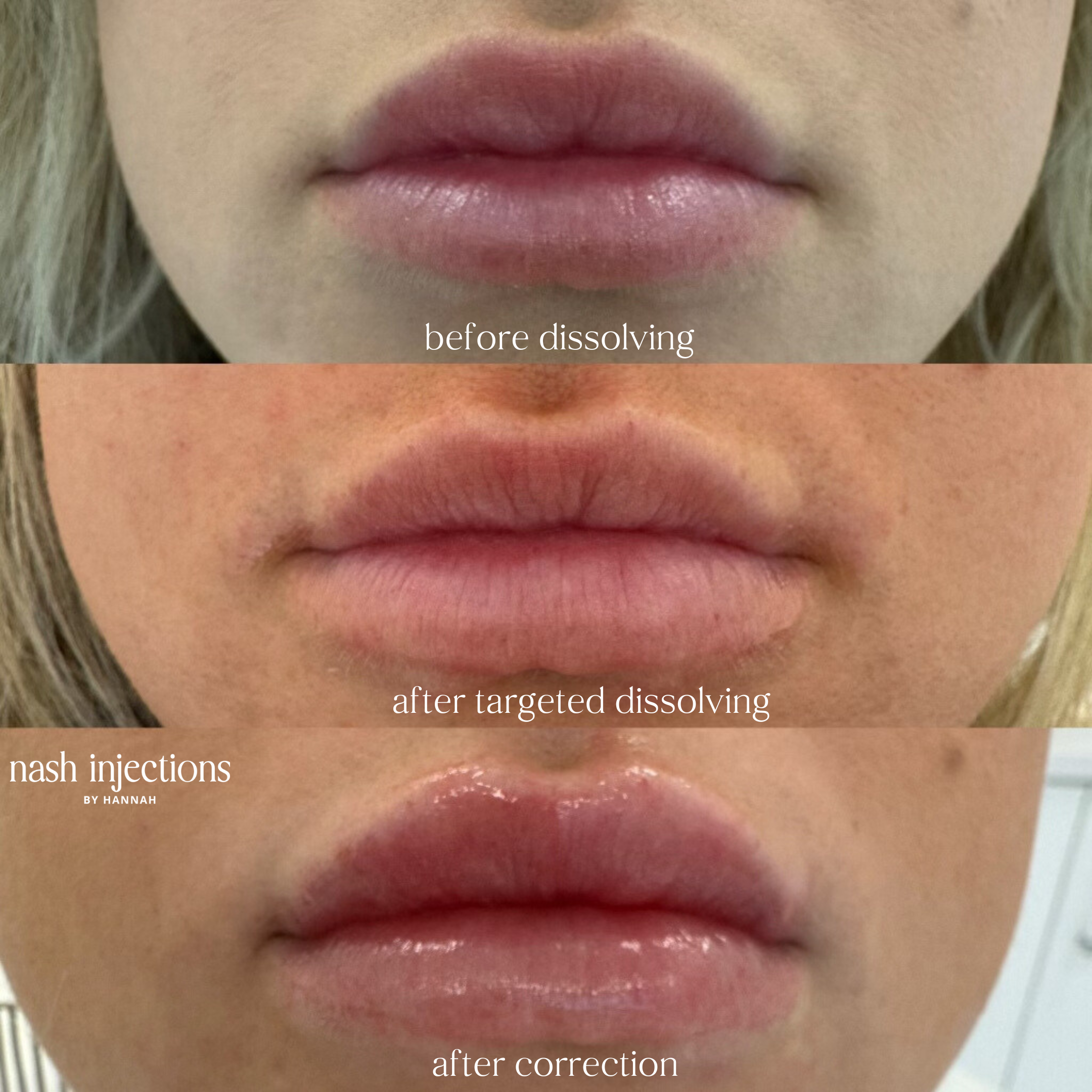 Before and After Dissolving Lip Filler