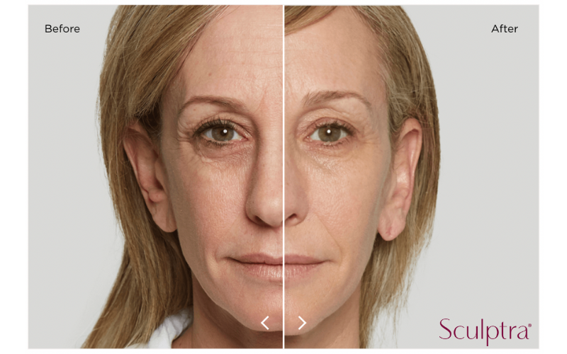 Before and After Sculptra