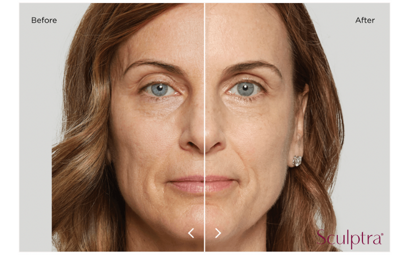 Before and After Sculptra