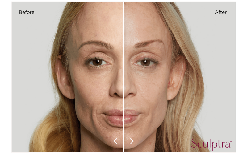 Before and After Sculptra Treatment