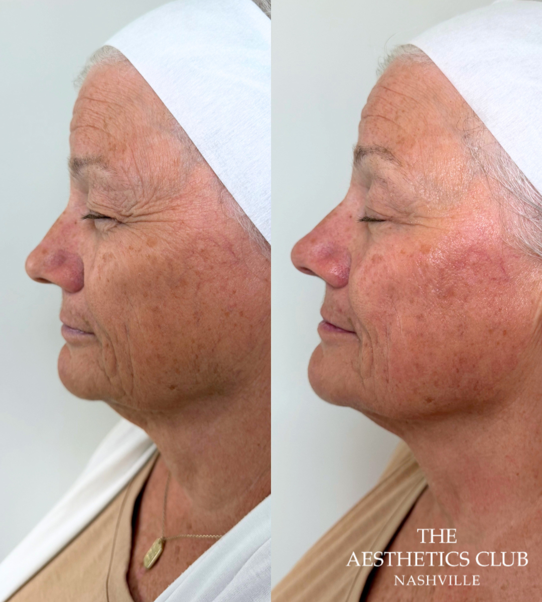 Woman before and immediately after one EVERESSE treatment showing improved facial firmness, texture, and contour