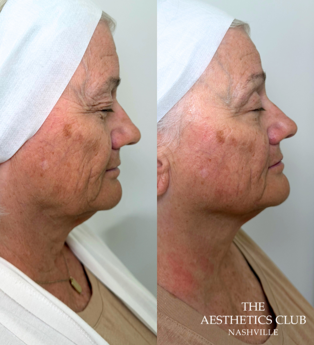 Woman before and immediately after one EVERESSE treatment showing visible improvement in skin firmness and facial contour
