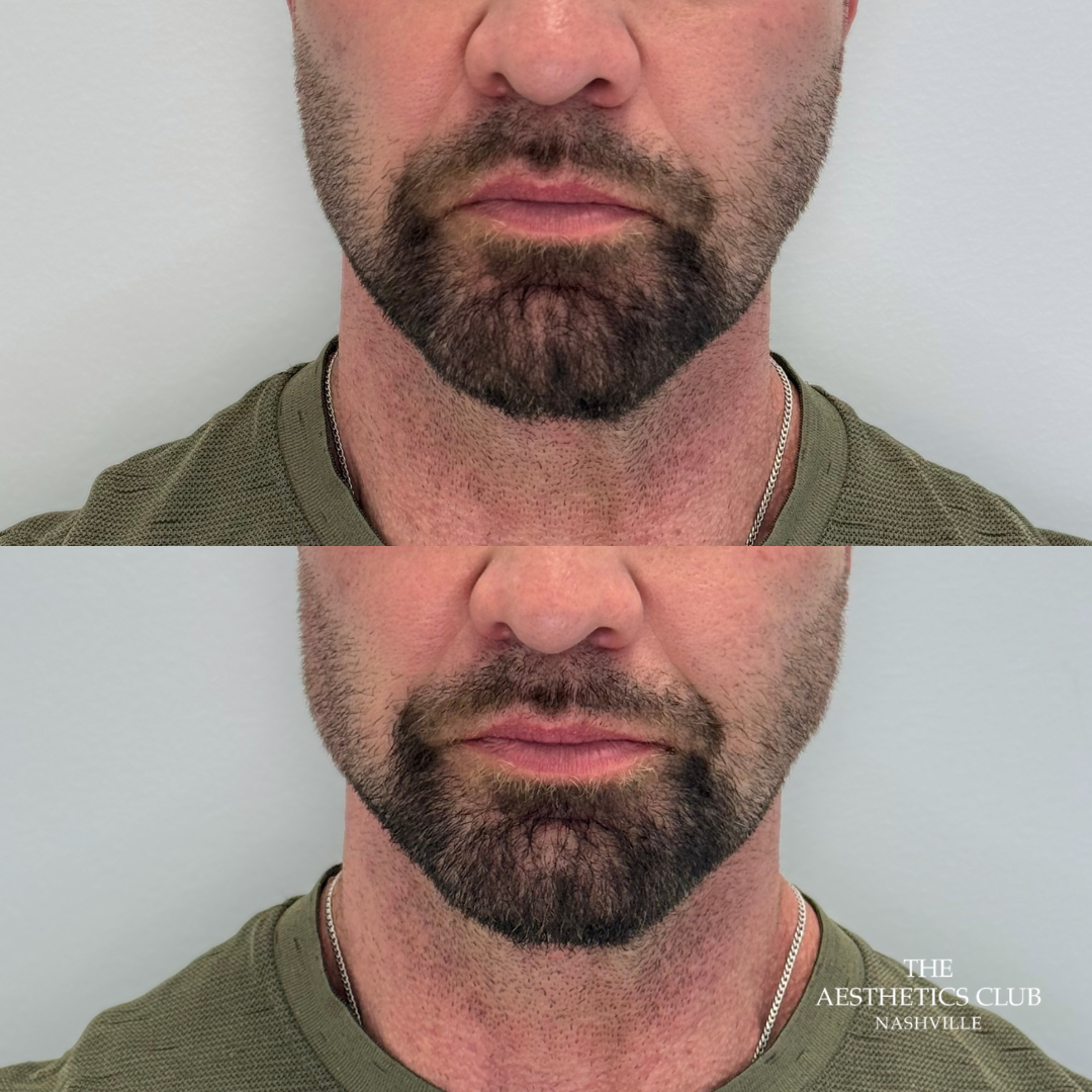 Jawline filler result by Hannah