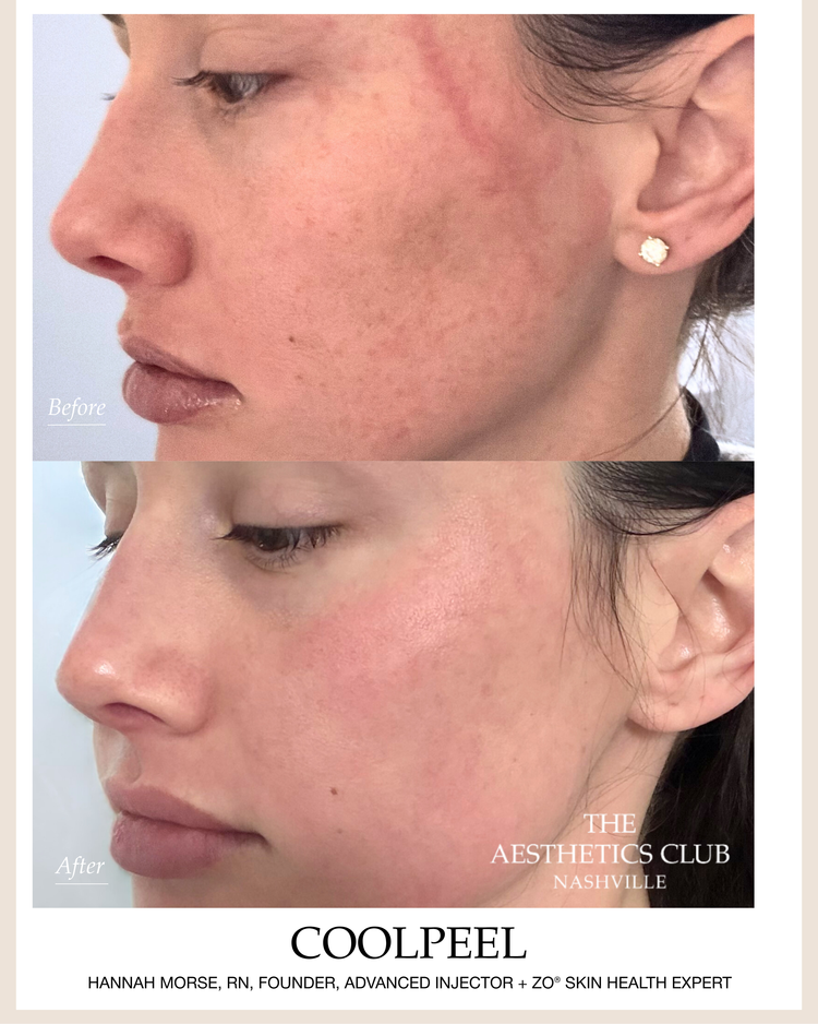 CoolPeel® before and after by Hannah Morse Cuffman RN