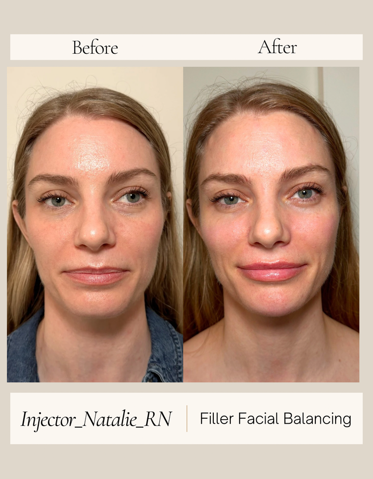 Cheeks, chin, and lips before and after by Natalie Ackley