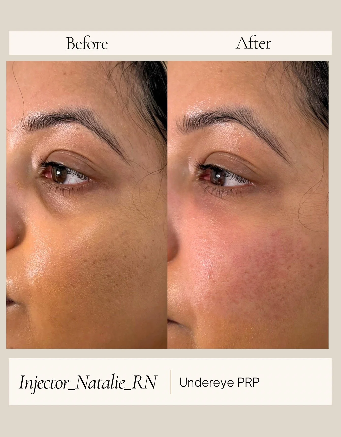 Under-eye PRP before and after by Natalie Ackley, RN at The Aesthetics Club Nashville