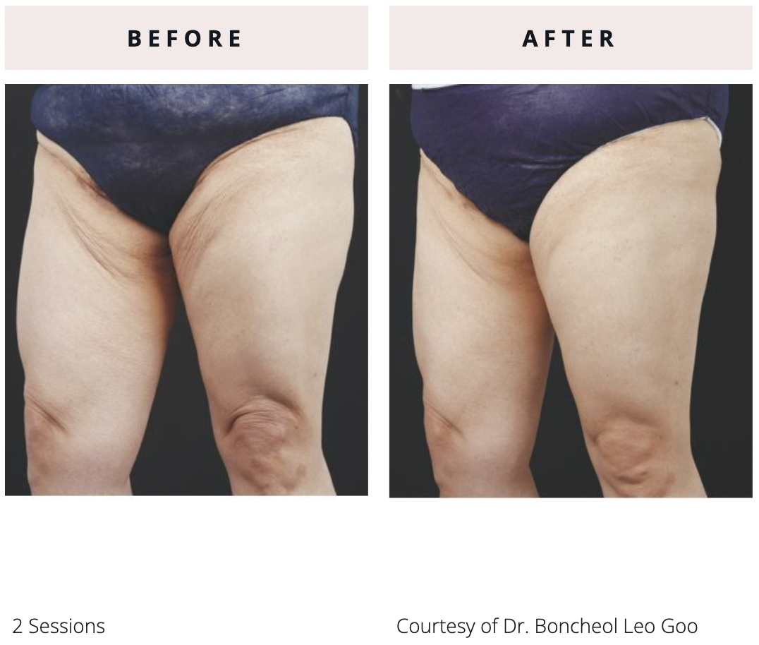 Before and after body treatment photos after 2 EVERESSE skin tightening sessions showing improved skin firmness and smoother appearance along the inner thighs with reduction in visible skin laxity.