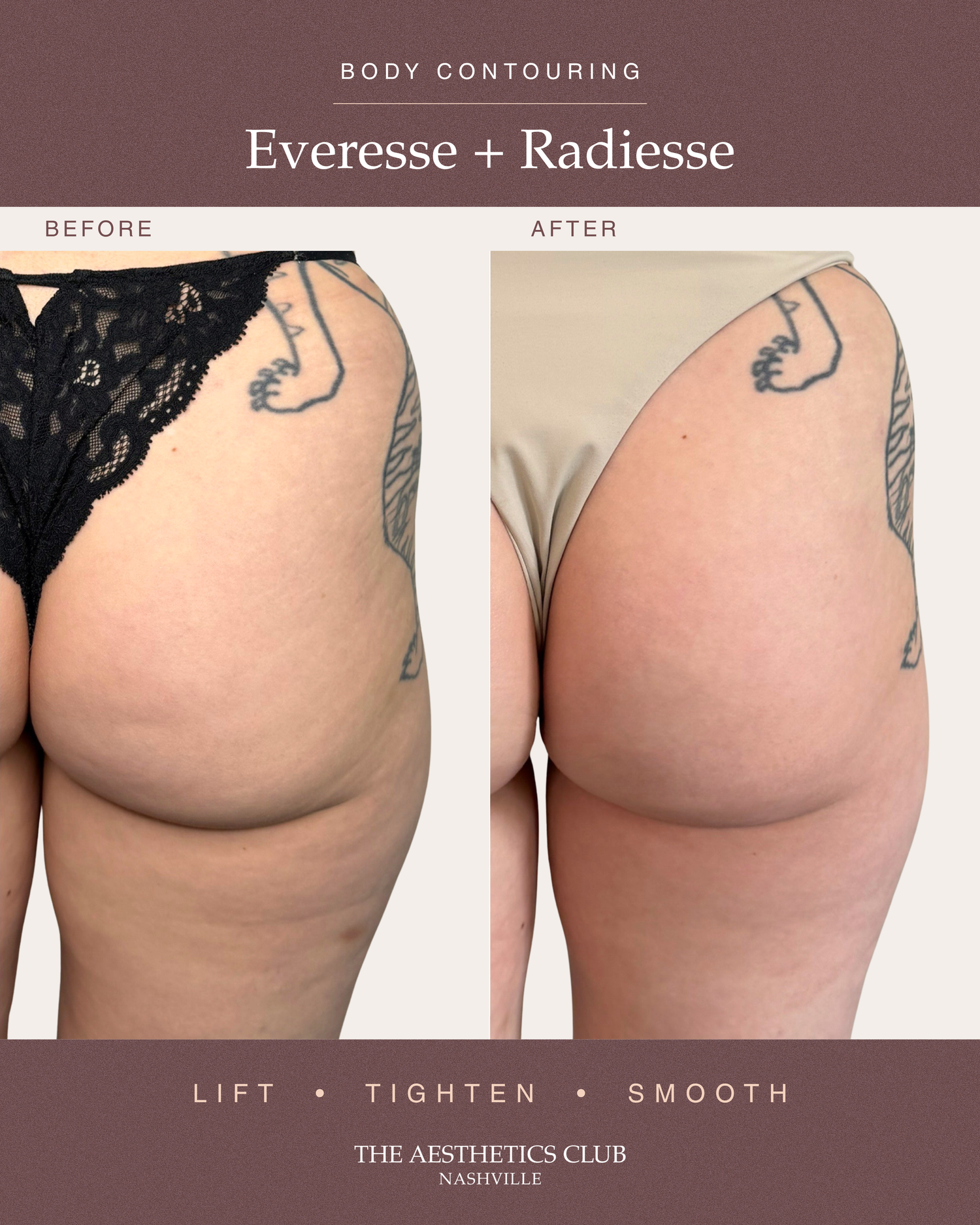 Before and after The Club Butt Lift combination treatment using Radiesse and EVERESSE RF
