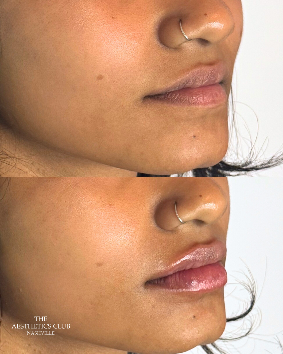 Lip filler result by Hannah