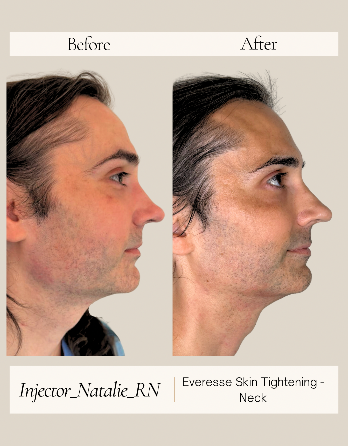 EVERESSE skin tightening before and after by Natalie Ackley, RN in Nashville