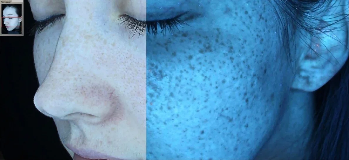 Close-up side profile skin analysis image comparing standard and UV light imaging to reveal pigmentation, sun damage, pores, and underlying skin concerns during a professional Glimpse skin evaluation.