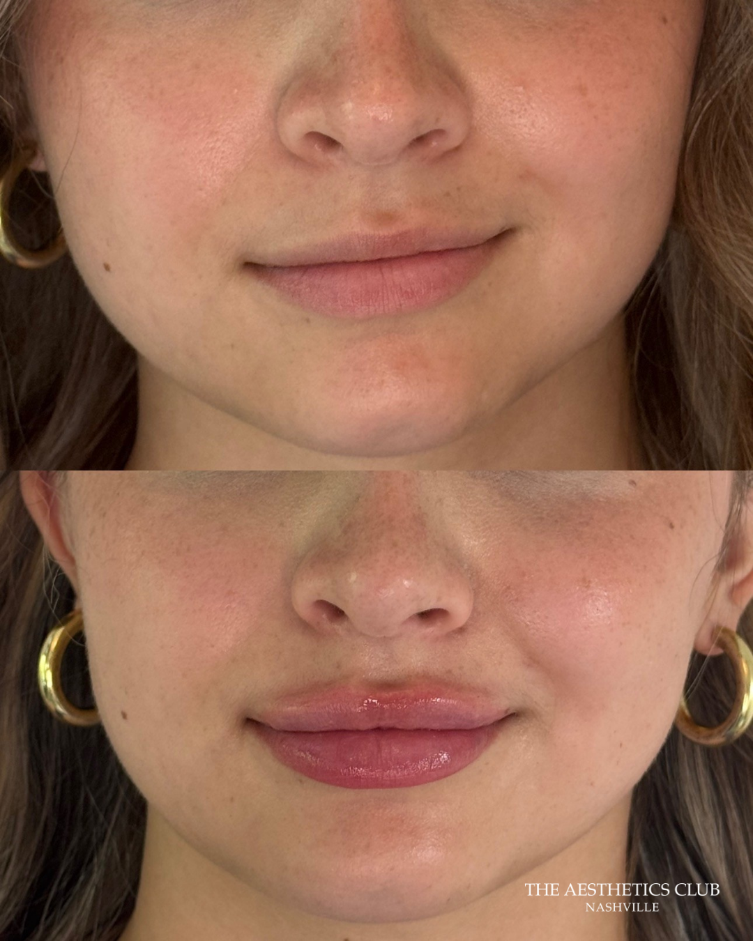 Lip filler result by Hannah