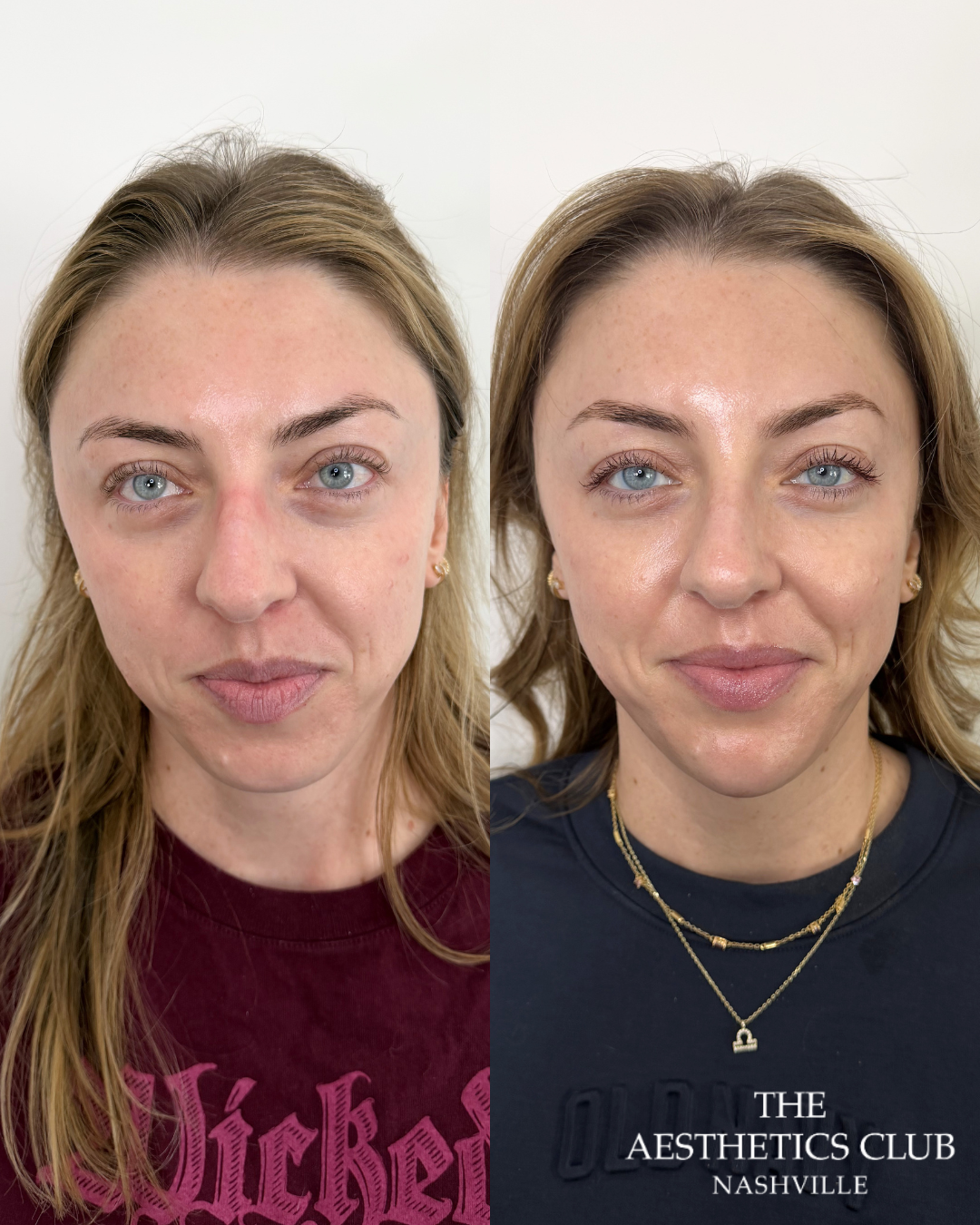 Cheek chin and jawline filler result by Natalie