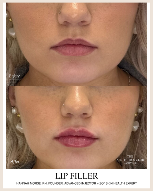 JUVÉDERM® Lip Filler before and after by Hannah Morse Cuffman RN