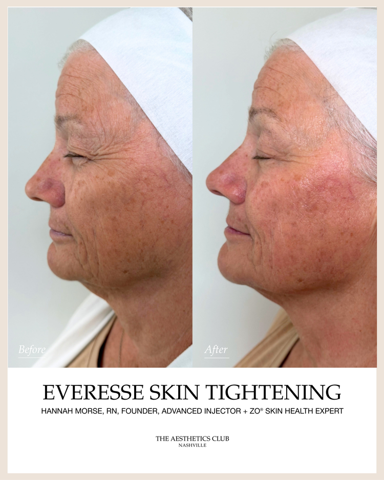 EVERESSE · Skin Tightening before and after by Hannah Morse Cuffman RN