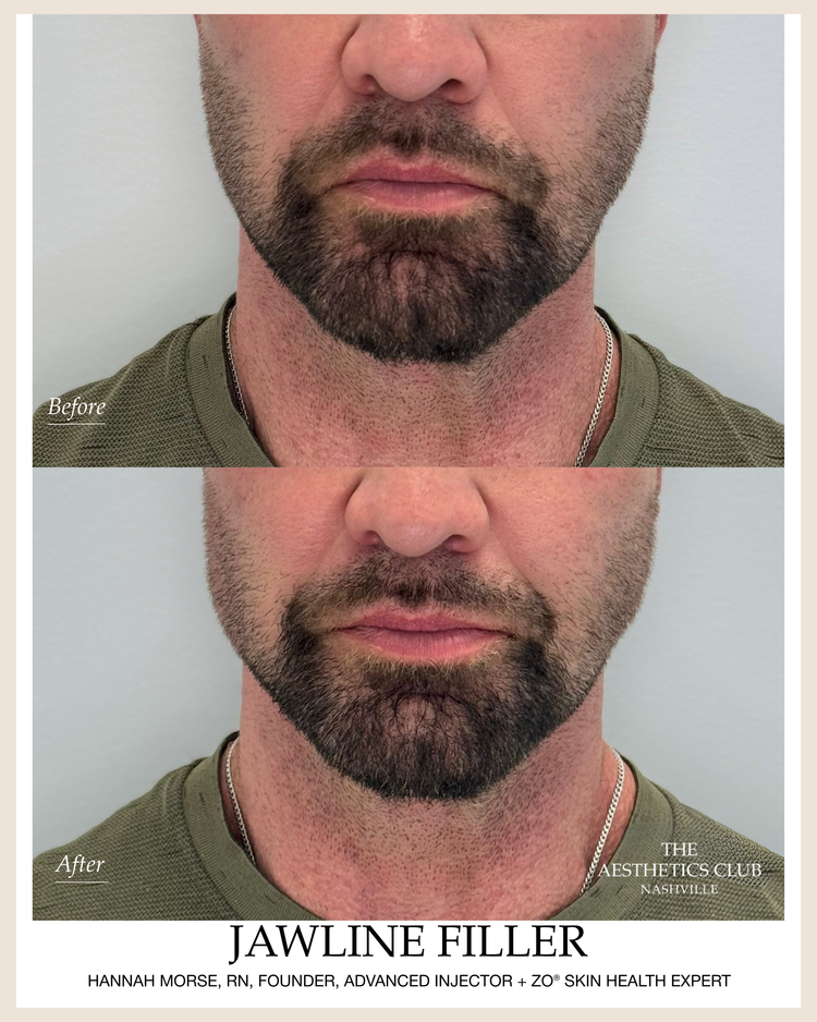 Male Jawline Filler before and after by Hannah Morse Cuffman RN