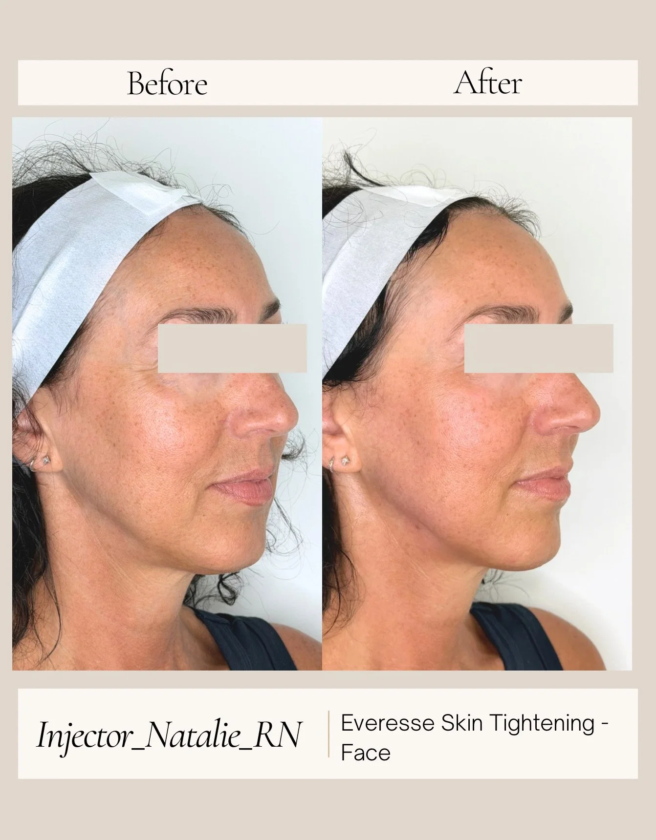 Woman before and immediately after one EVERESSE treatment showing visible improvement in facial firmness, contour, and overall skin quality