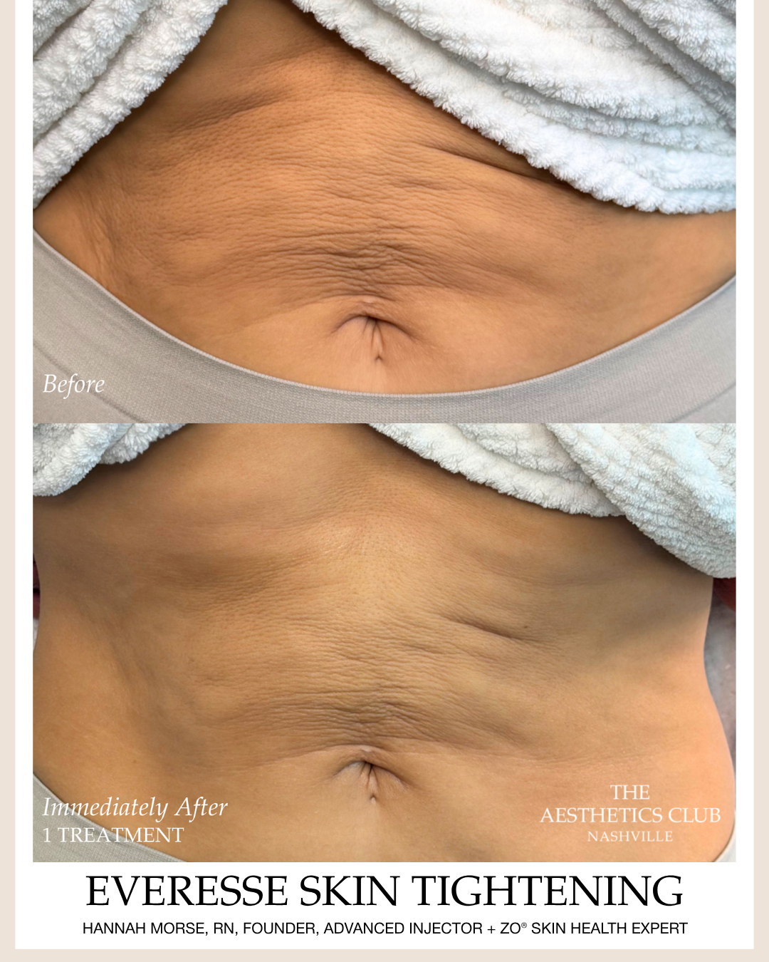 Before and after EVERESSE skin tightening treatment to the abdomen at The Aesthetics Club Nashville