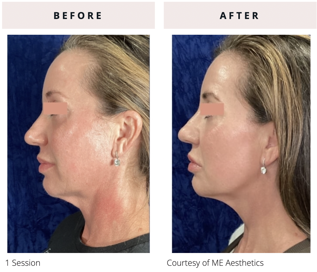 Side-profile before and after of EVERESSE skin tightening after 1 session showing visible lifting and tightening along the jawline and neck with improved skin firmness and contour definition.