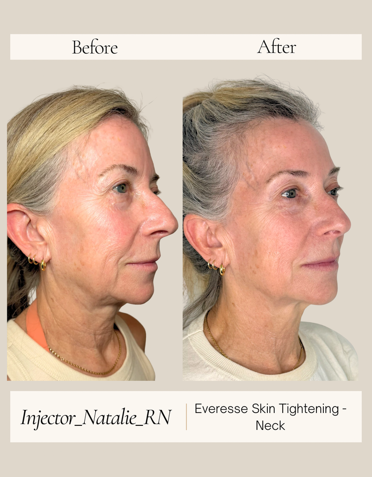Woman before and immediately after one EVERESSE treatment showing improved facial firmness, texture, and contour
