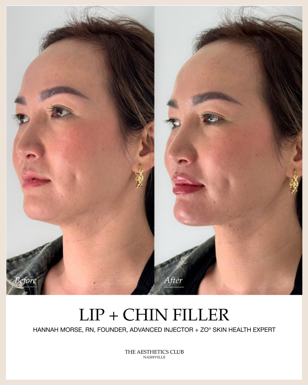 Facial balancing before and after in Nashville