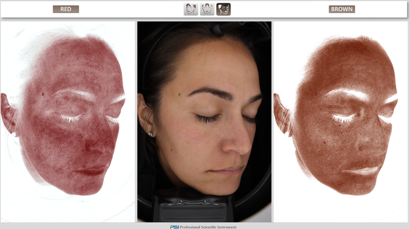 Professional skin analysis imaging comparing red and brown pigmentation patterns on the face to evaluate redness, inflammation, sun damage, and uneven skin tone during a Glimpse skin evaluation.