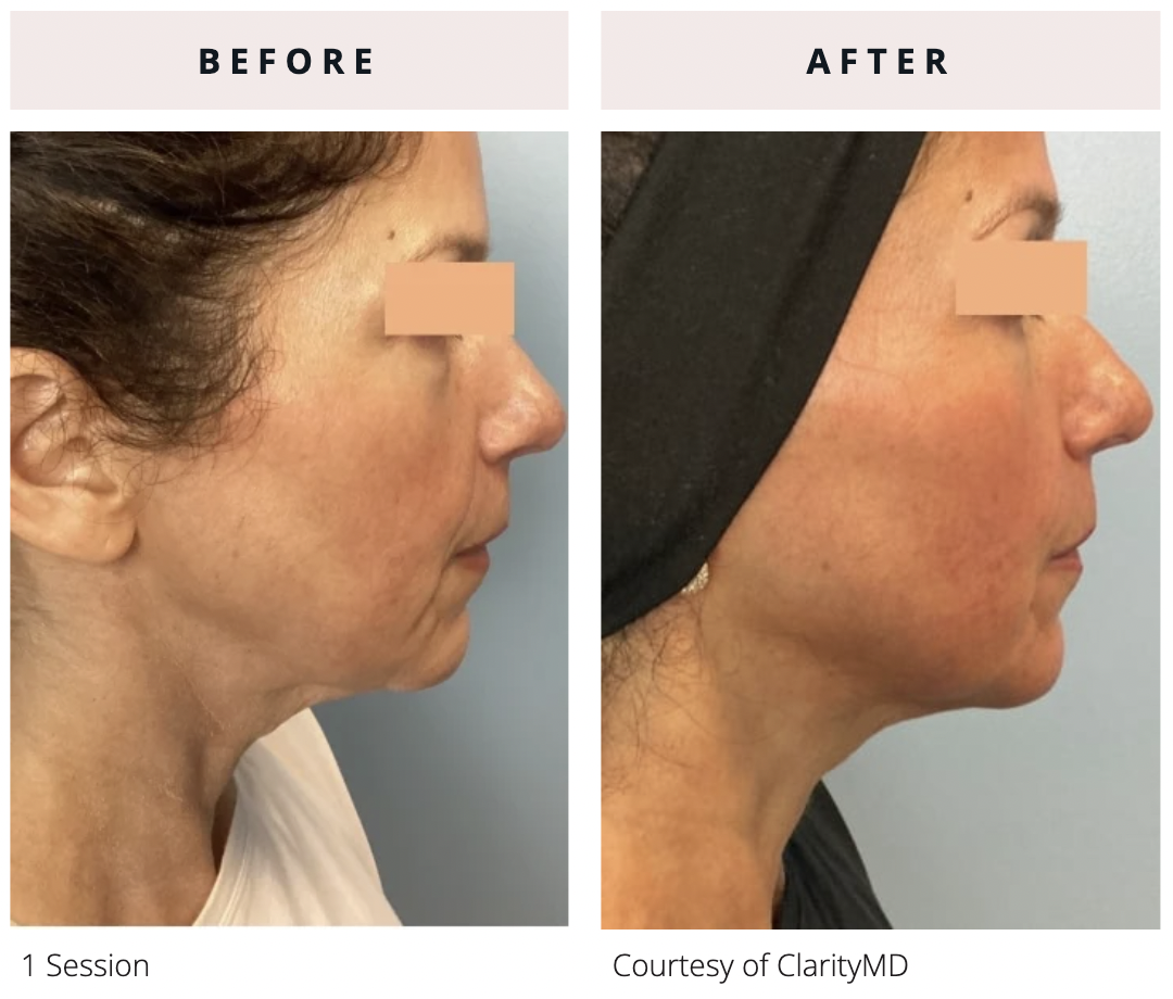 Side-profile before and after of EVERESSE skin tightening after 1 session showing visible improvement in jawline definition, lower face tightening, and reduction in skin laxity along the chin and neck.