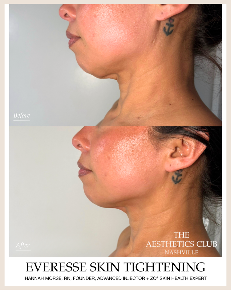 EVERESSE · Neck before and after by Hannah Morse Cuffman RN
