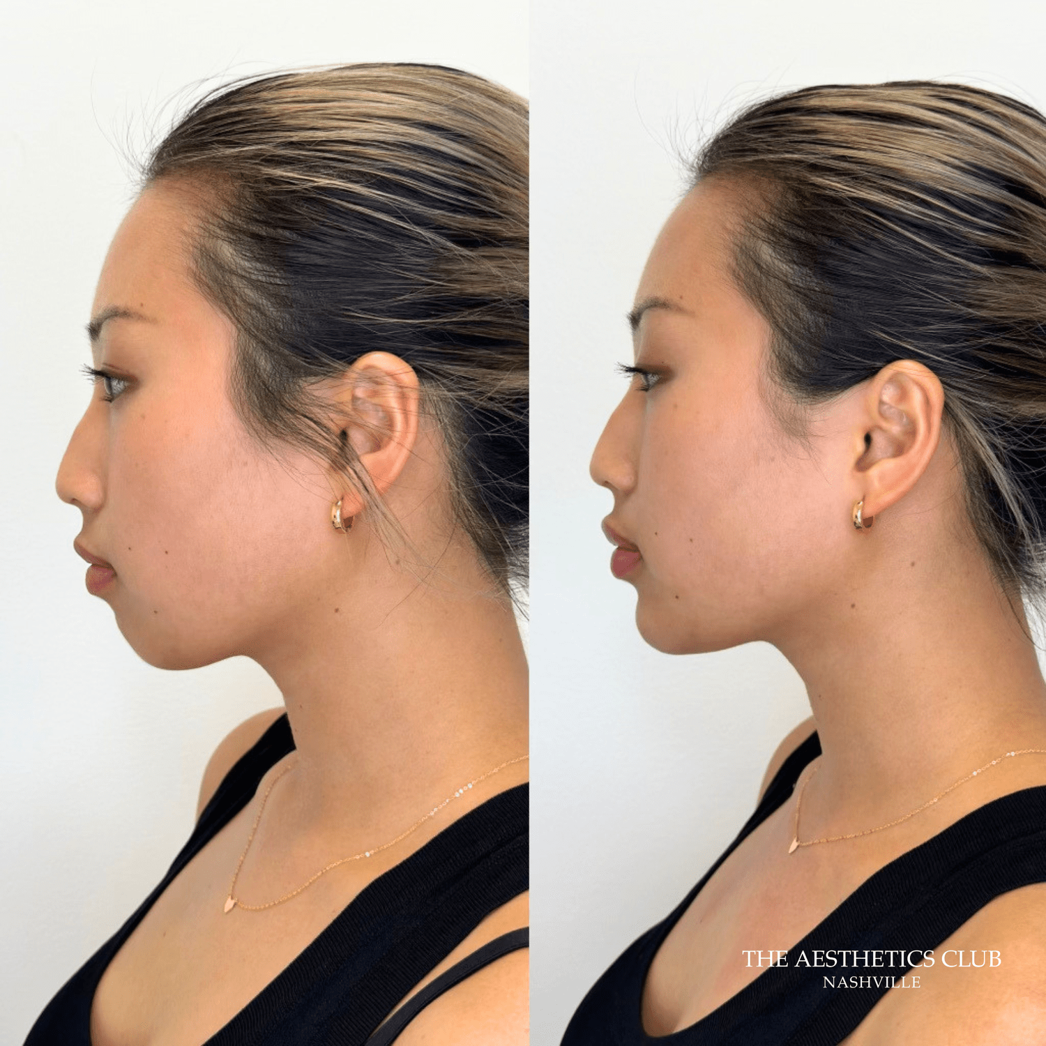 Lip and chin filler result by Hannah