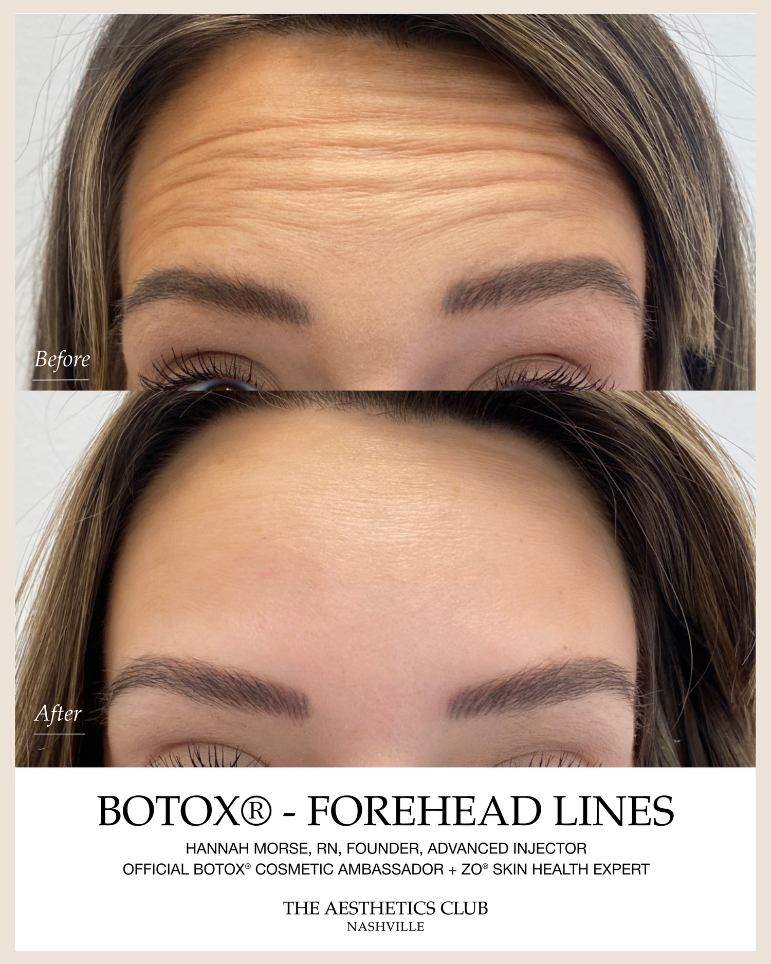 Before and after Forehead lines Botox treatment by Hannah Morse Cuffman RN at The Aesthetics Club Nashville, Forehead · Client 1