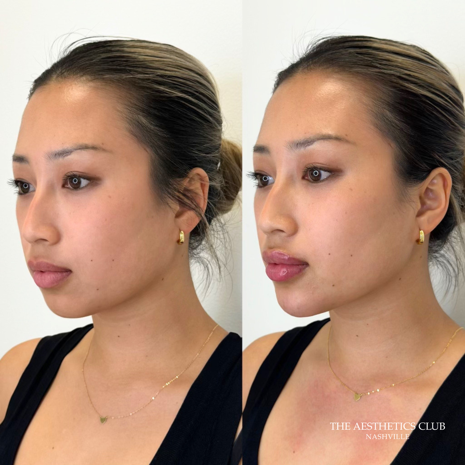 Lip and chin filler result by Hannah