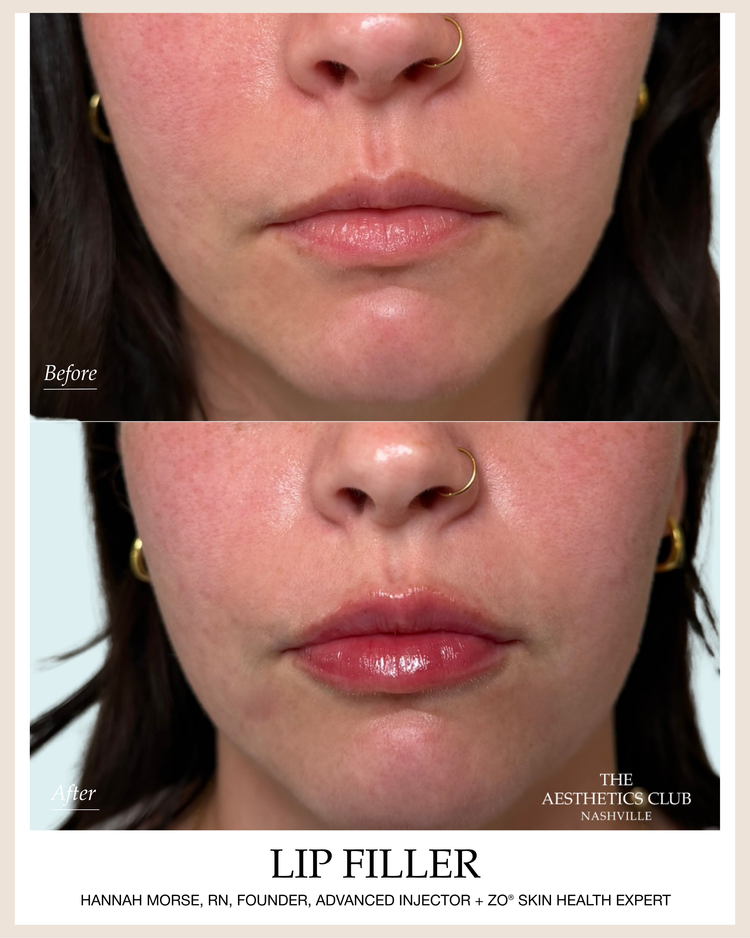 Lip filler before and after in Nashville
