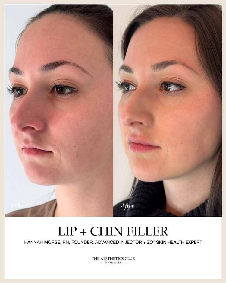 Facial Balancing · Lip + Chin before and after by Hannah Morse Cuffman RN