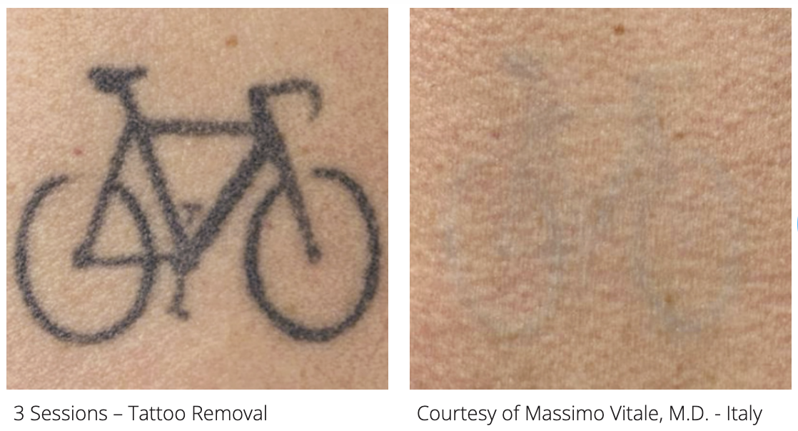 before and after tattoo removal