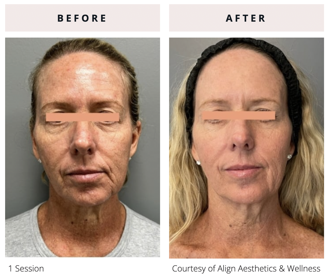 Front-facing before and after of EVERESSE skin tightening after 1 session showing improvement in skin firmness, texture, and overall facial smoothness with a more lifted appearance along the cheeks, jawline, and neck.