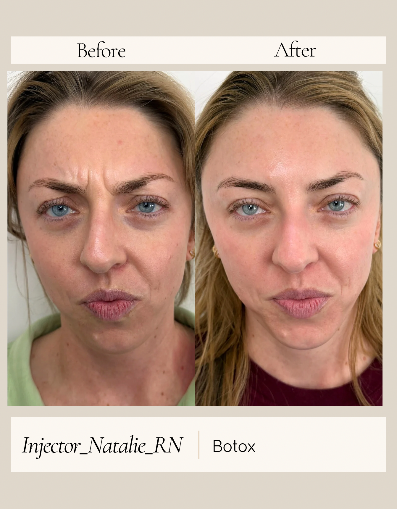 Botox before and after by Natalie Ackley