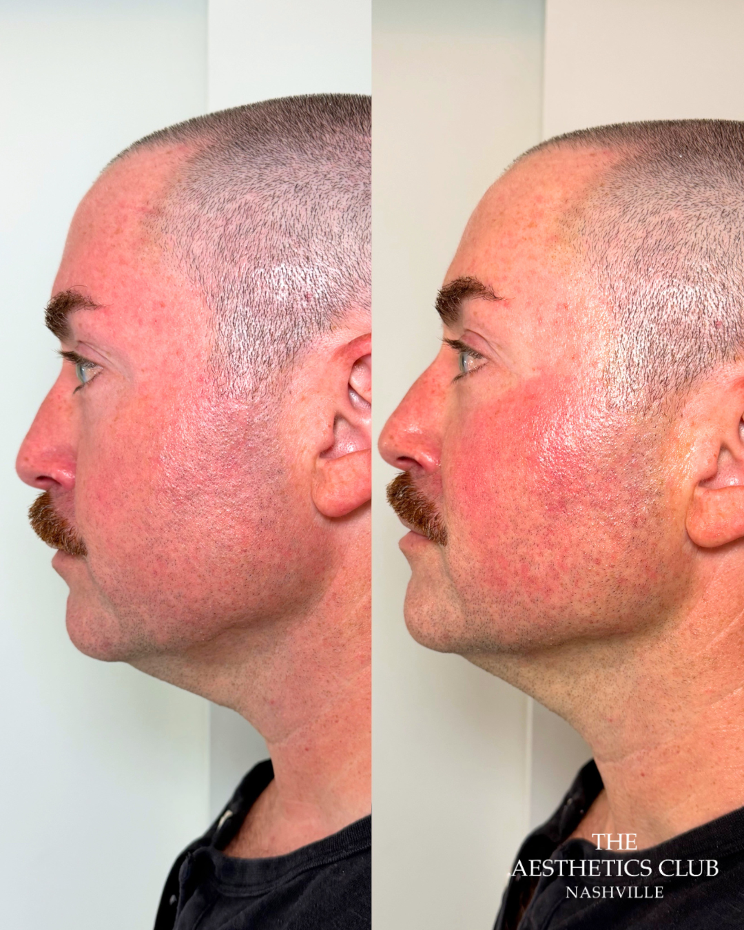 Man before and immediately after one EVERESSE treatment showing visible improvement in lower-face contour and skin firmness