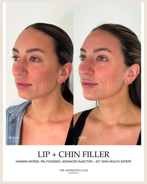 Chin + Lip Filler before and after by Hannah Morse Cuffman RN