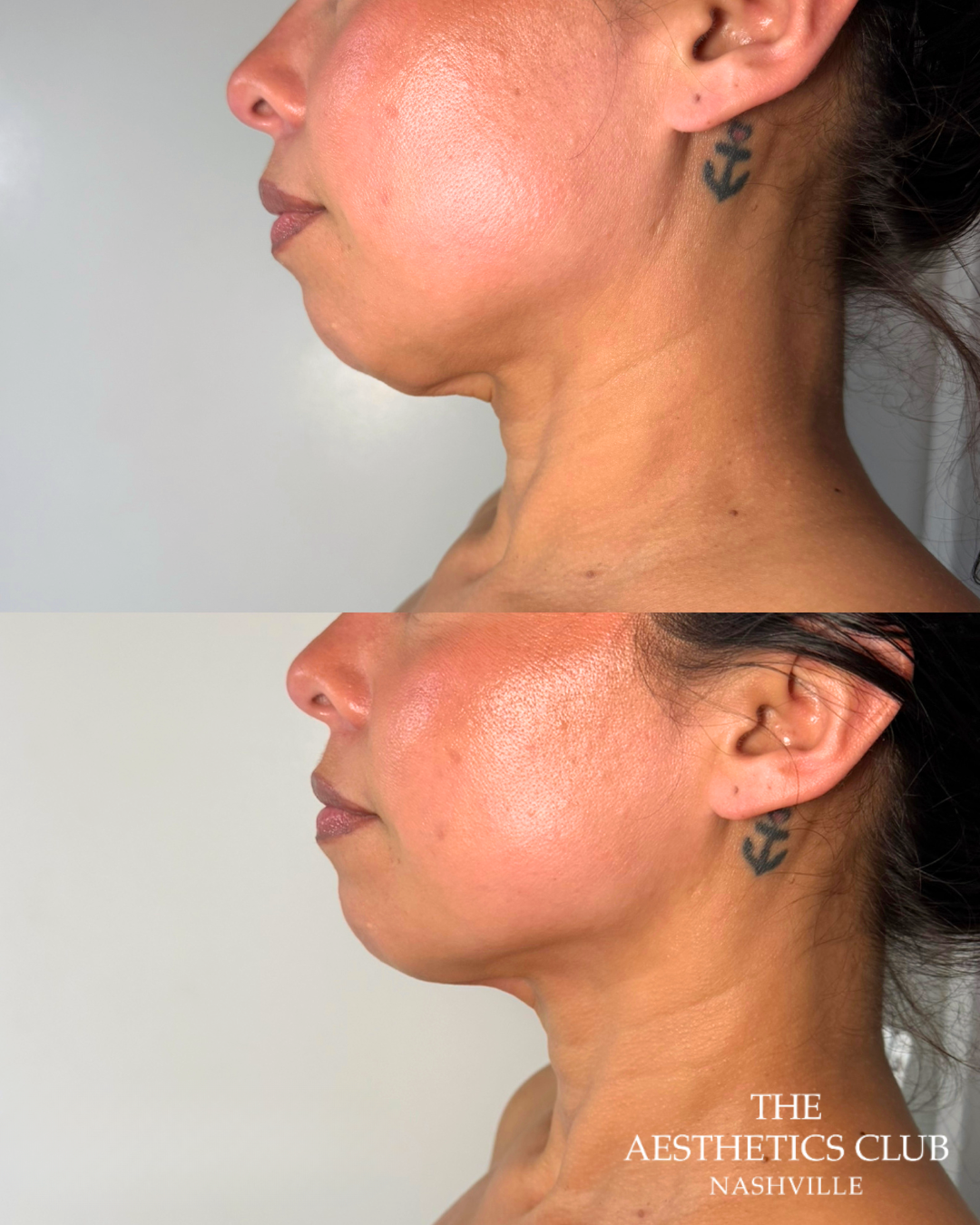 Woman before and immediately after one EVERESSE treatment showing improved lower-face firmness and jawline definition